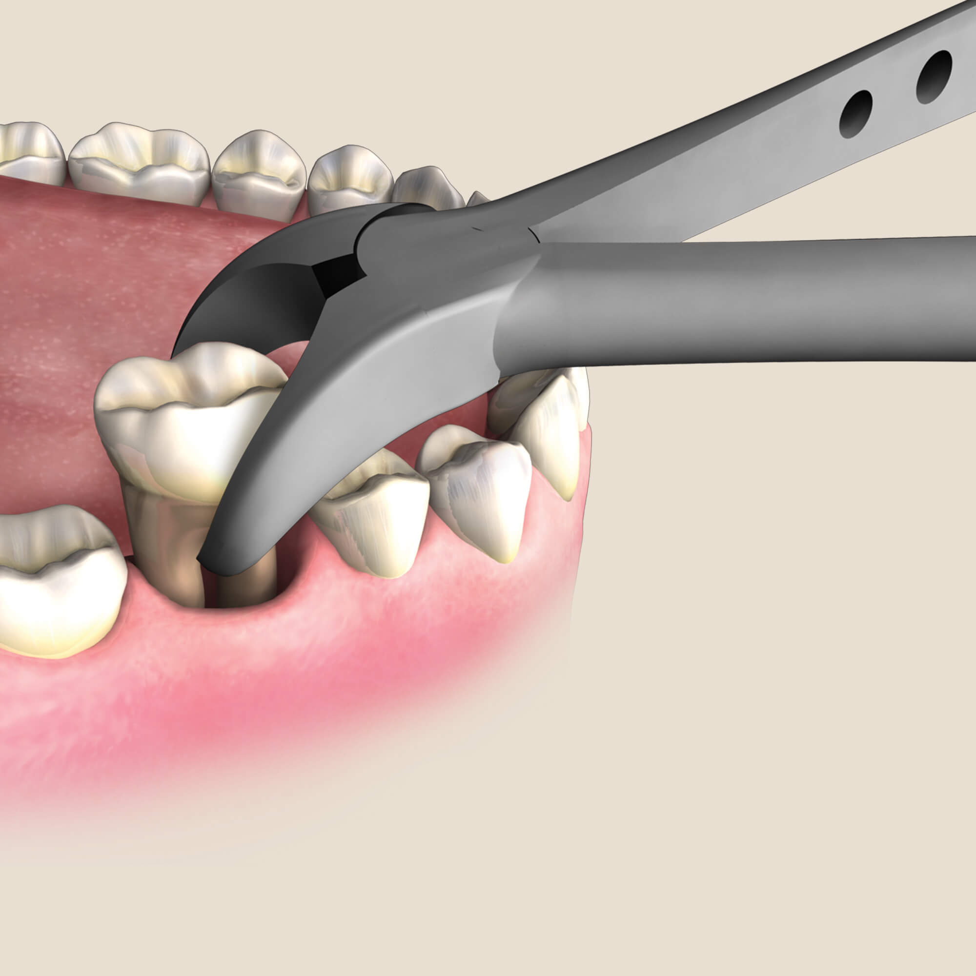 Dental Extraction Forceps